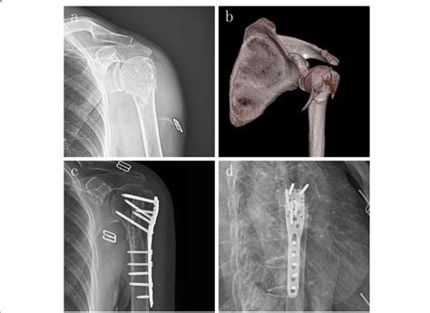 A Case Of A 3 Part Fracture With Severe Metaphyseal Comminution A