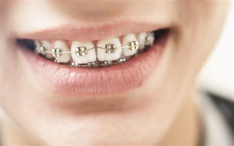 reasons   braces sing orthodontics