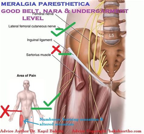 Meralgia Paresthetica Patient Handout Sexiz Pix
