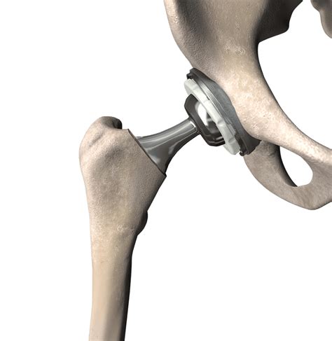 Hip Replacement Surgeon Airmid Hospital