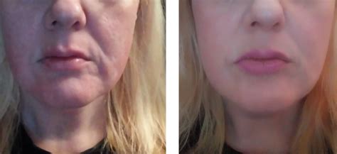 Radio Frequency Skin Tightening Bellissimo You