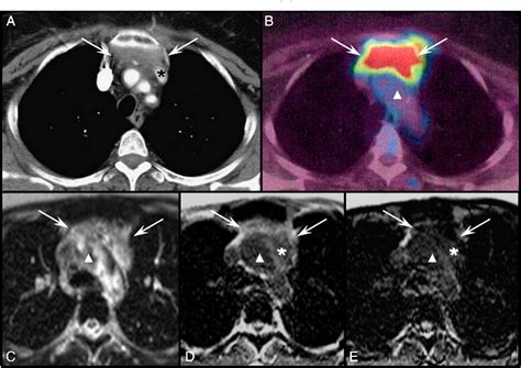 Figure 2 From Chemical Shift Mri Of Rebound Thymic Hyperplasia With