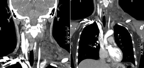 A 40 Year Old Female With An Acute Onset Left Lateral Neck And