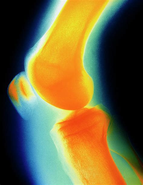 Coloured X Ray Image Of A Normal Knee Joint Photograph By Dept Of