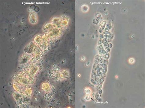 White Cells Casts In Urine Medical Laboratories