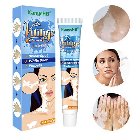 20g Vitiligo Treatment Cream Remove White Spots Ringworm Leukoplakia