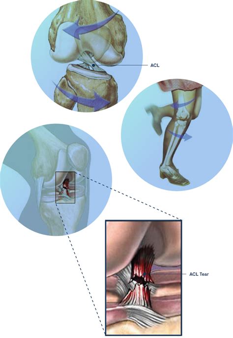 Anterior Cruciate Ligament Rupture Acl Lesion Clínica Do Joelho E Ombro Prof Gutierres