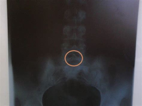X Ray Spina Bifida Occulta Medicine Hack