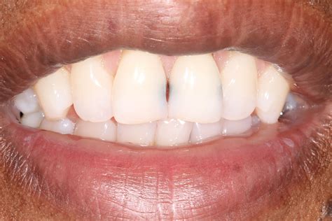 Front Tooth Cavity