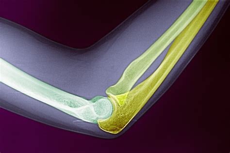 Signs Of An Olecranon Fracture Or Broken Elbow Bone