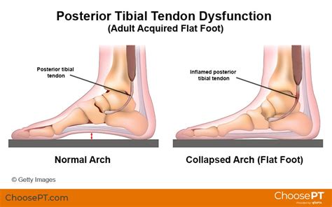 Guide Physical Therapy Guide To Posterior Tibial Tendon Dysfunction Choose Pt