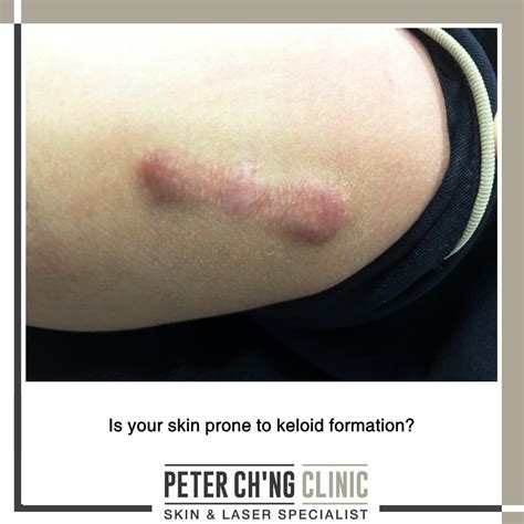 4 Steps To Prevent A Keloid Scar Formation Peter Ch Ng Skin