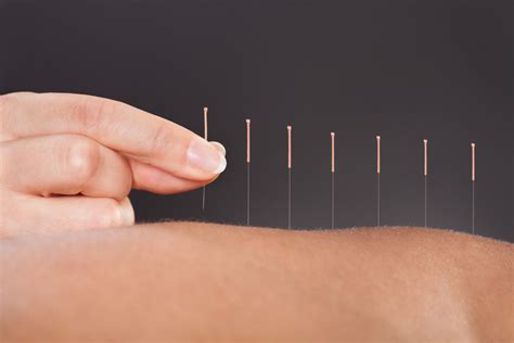 acupuncture and dry needling headon physio