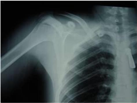 Figure 1 From Treatment Of Medial Clavicle Fractures A Case Report