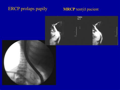 Ppt Ercp X Mrcp Powerpoint Presentation Free Download Id898145