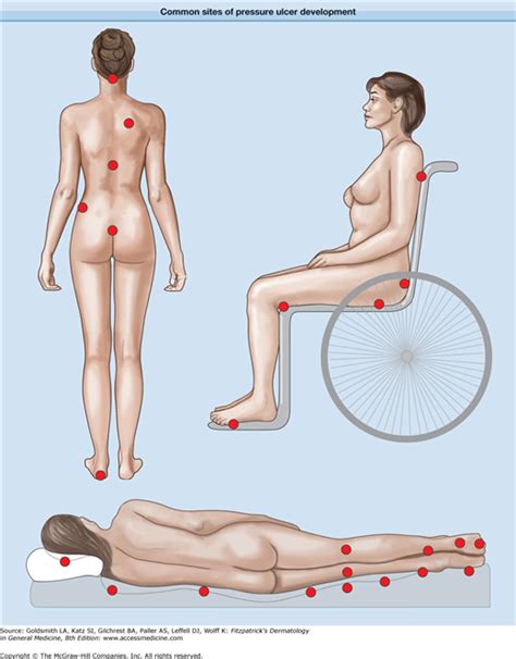 Decubitus Pressure Ulcers Plastic Surgery Key