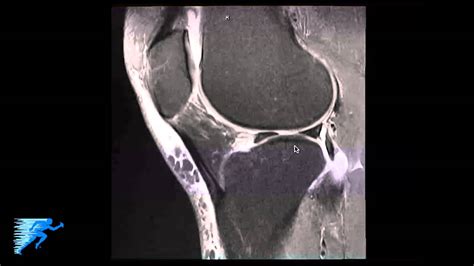 How To Read Knee Mri Of Meniscal Root Tear Knee Surgery Recovery Time