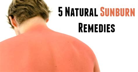 5 Natural Sunburn Remedies Natural Holistic Life