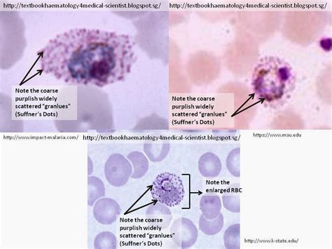 Haematology In A Nutshell Plasmodium Vivax In Thick And Thin Films