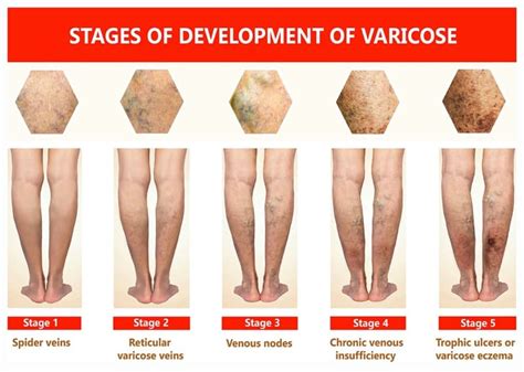 6 Stages Of Vein Disease Every Person Needs To Know Veinly