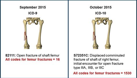 Icd 10 Code For Left Femur Fracture 99degree