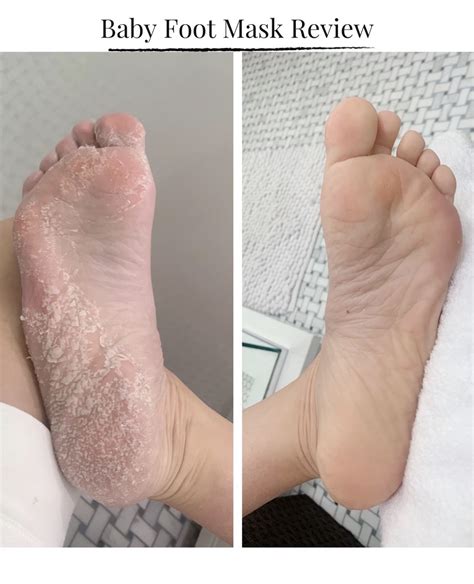 Foot Peel Mask Review Before And After See Anna Jane