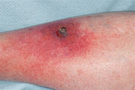 Cellulitis Photograph By Dr P Marazziscience Photo Library