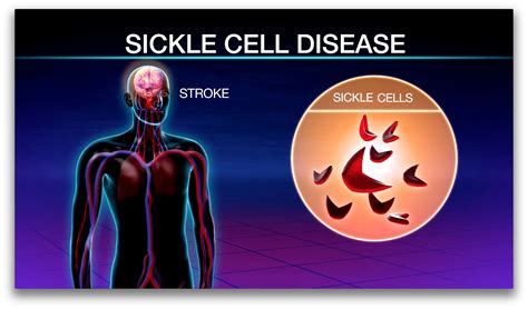 Can Bone Marrow Transplants Improve Outcomes For Adults With Sickle Cell Disease The Doctors