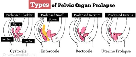 Pelvic Organ Prolapse Types Causes Symptoms Diagnosis Treatment Prevention