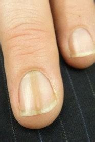 Try soaking your finger in a water/peroxide mix. Next Time You Polish Your Nails, Please Do This First--It ...