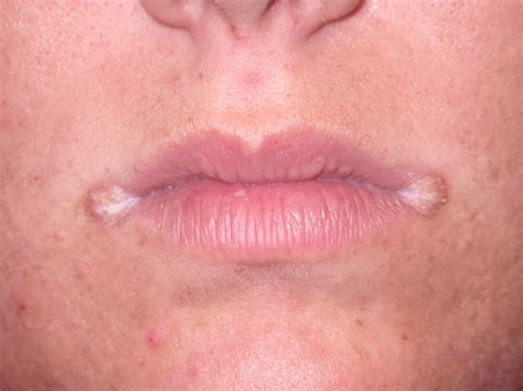 White Spots Under Skin In Corner Of Lips Lips Makeupview