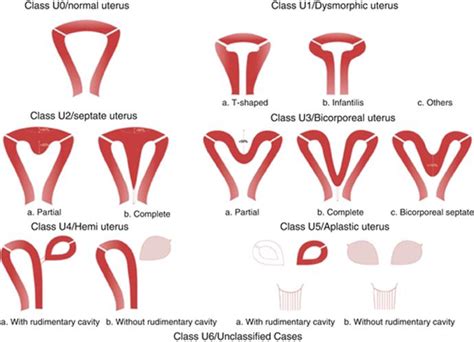 Abnormal Development Of The Female Genital Tract Atlas Of Surgical