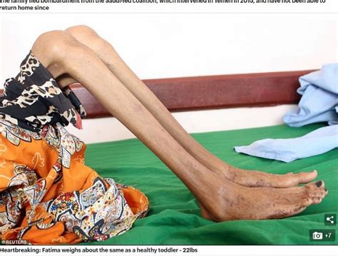 イエメン内戦で“体重10kg”まで痩せた少女の姿に全世界衝撃！ 完全に「骨と皮」で医者も治療拒否 飢餓千万人の絶望的状況ｰオカルトニュース