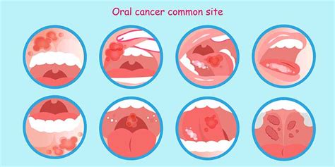 Check Your Mouth In Honor Of Oral Cancer Awareness Month
