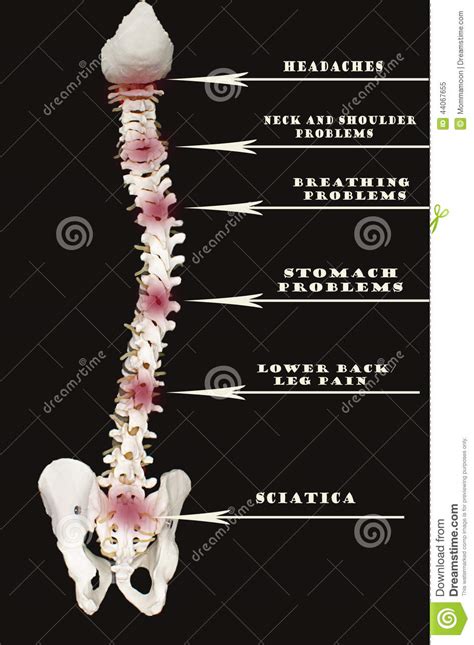 The court areas of a typical basketball court include back court : Spine Labeled By Areas Affected Stock Illustration ...