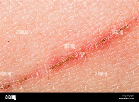 Scratch Skin Hi Res Stock Photography And Images Alamy