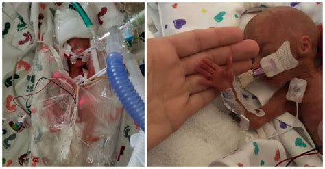 Micro Preemie Finally Gets To Go Home After 153 Days In The Hospital