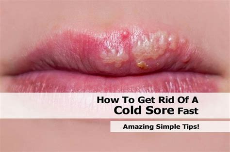Ideas And Products How To Get Rid Of A Cold Sore Fast