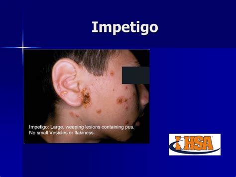 Ppt Common Skin Conditions In Wrestling Powerpoint Presentation Free
