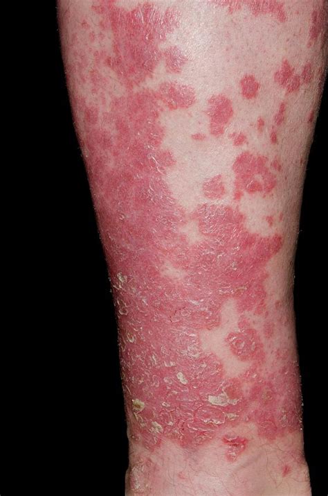 Psoriasis On The Leg Photograph By Dr P Marazziscience Photo Library