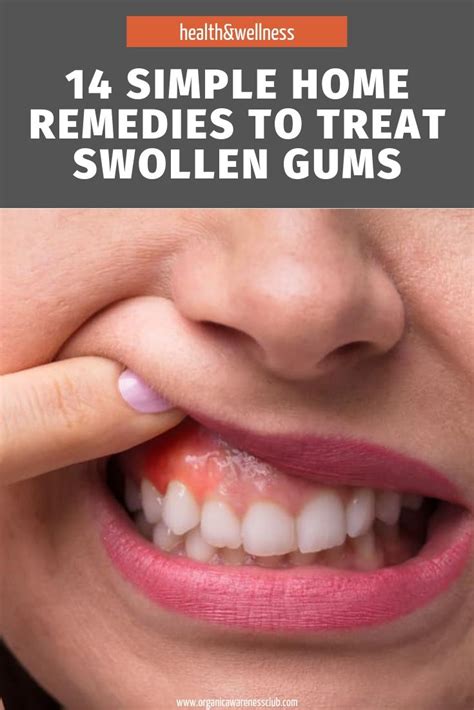 14 Simple Home Remedies To Treat Swollen Gums Swollen Gums Remedy