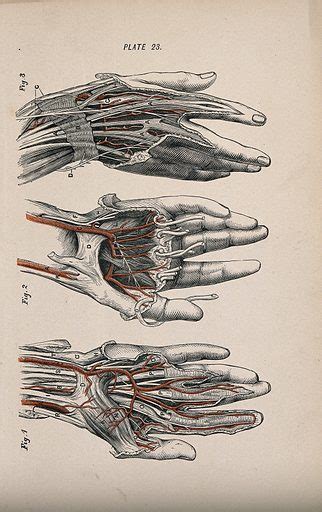 Dissection Of The Hand And Fingers Three Figures Showing The Free