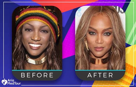 Nose Job Before And After Celebrities