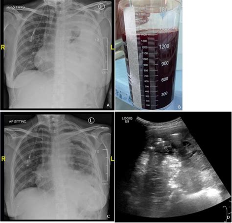 How To Drain A Pleural Effusion Best Drain Photos Primagem Org