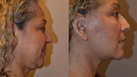 Neck Lift Without Facelift How Well Does It Work Lookyoungernews