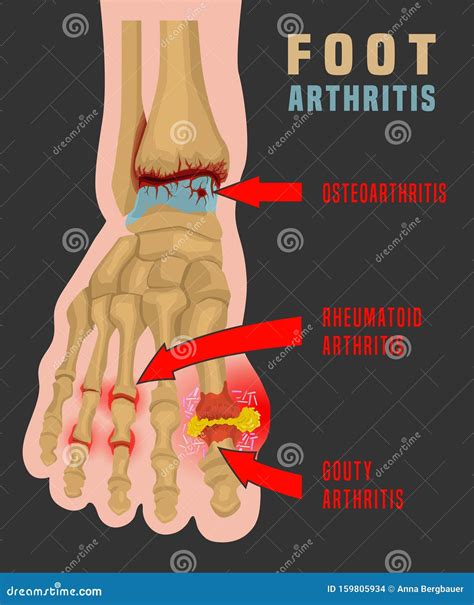 Foot Arthritis Infographic Stock Vector Illustration Of Hallux 159805934