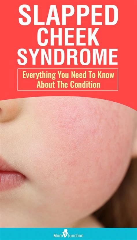 Slapped Cheek Syndrome Everything You Need To Know About The Condition