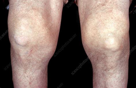 How Painful Is Gout In The Knee