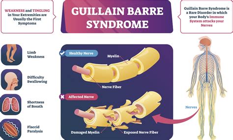 Rare Neurological Disorder Guillain Barre Syndrome Linked To COVID 19