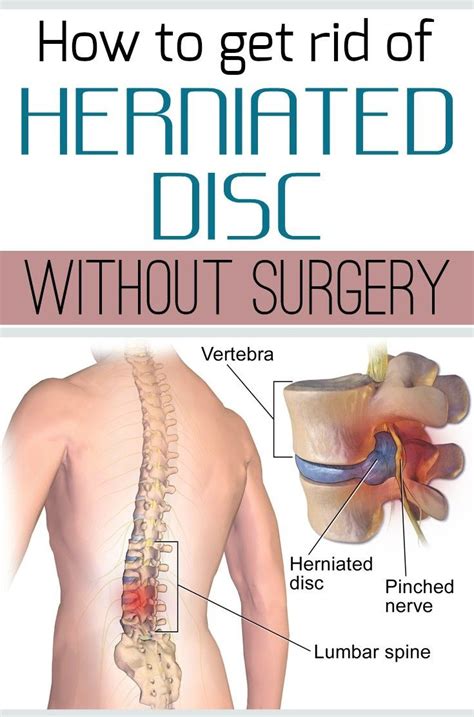 If you can commit to a more drastic change, the best sleeping position for your herniated disc pain may be your back. How to get rid of herniated disc without surgery ...